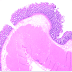 MENDEL MASTERY SERIES™: ENDOSCOPIC GI BIOPSIES