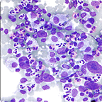 MENDEL MASTERY SERIES™: LYMPHOMAS
