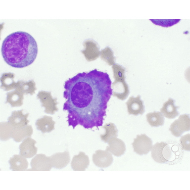 Multiple Myeloma