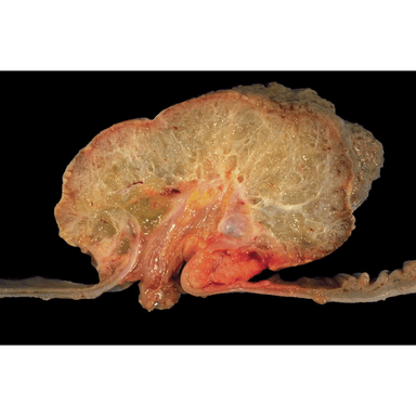 Chondrosarcoma - gross