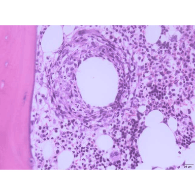 Donut granuloma, Q fever