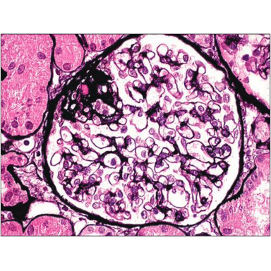 Kidney FSGS