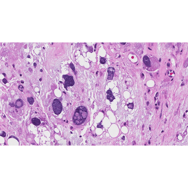 Pleomorphic liposarcoma