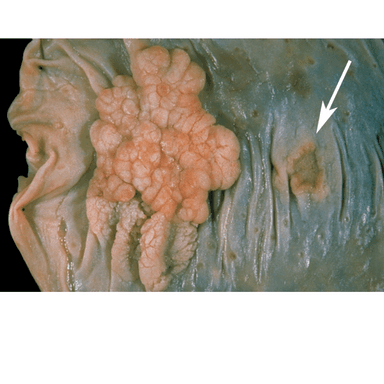 Polyp with cancer
